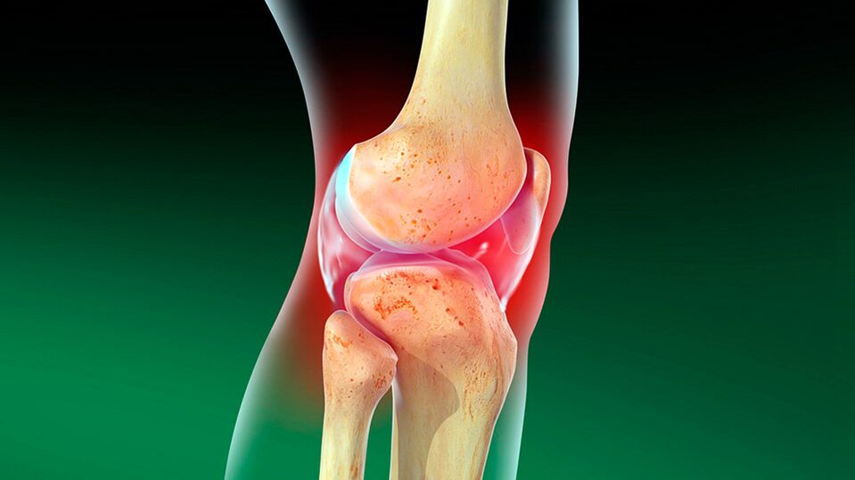 Diz ekleminin osteoartriti